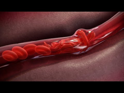 Voxelotor An Investigational Drug for Sickle Cell Disease