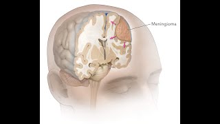 brain_tumor meningioma neurosurgery bangladesh_specilized_hospital