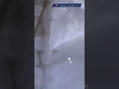 عملية فتح شريان قلبي خطيرة الدكتور عمرو رشيد الاردن القلب صحة   