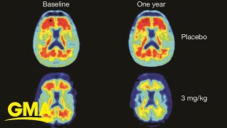 Celebrity New study may be shedding light on whether anti-inflammatory drugs can prevent Alzheimer's l GMA Net Worth