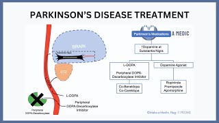 Parkinson's Disease Treatment Explained