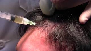 Injecting Platelet rich Plasma PRP for the Treatment of Hair loss