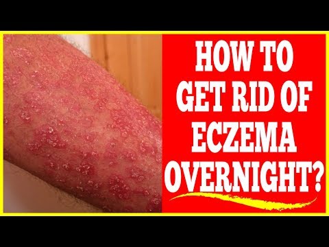 How To Get Rid Of Eczema Rash Overnight