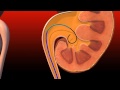 Ureteral Obstruction - Retrograde insertion of Resonance stent