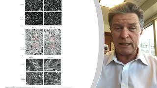2020 Clinical Research Forum Top Ten | Precision-Based Therapy in Complex Lymphatic Anomalies