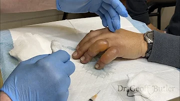 Drainage of blisters secondary to frostbite
