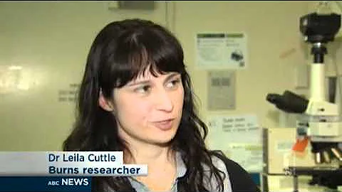 Proper burns first aid essential: doctors