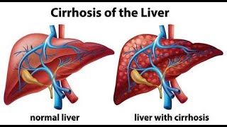 (cadiac cirrhosis & budd chiari syndrom ) liver cirrhosis شرح