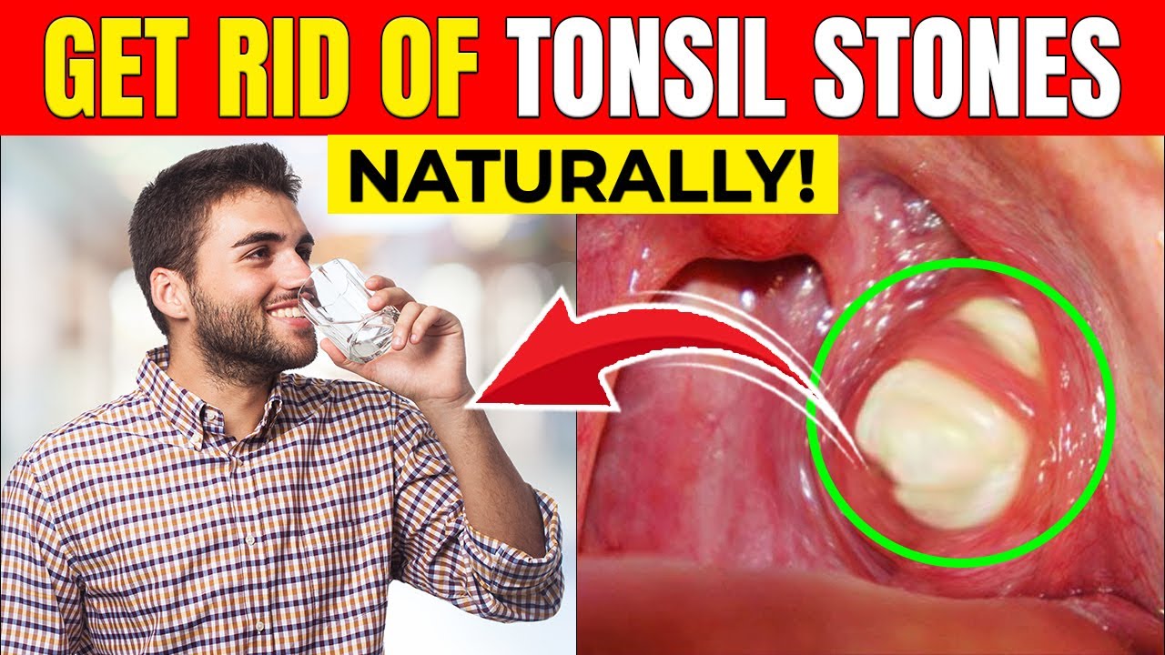 Tonsil Stones: The Hidden Cause of Bad Breath (And How to Remove Them ...