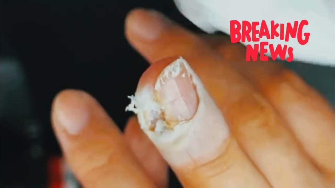 una casa feet warts remove jigger ingrown KinTin68 professional YouTube