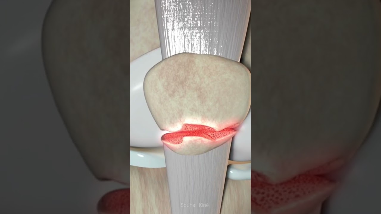 Lower pole patella fracture