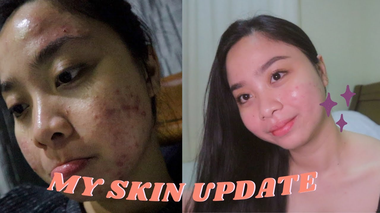 WORTH IT BA ANG ISOTRETINOIN? - my 3 months progress + new products on ...