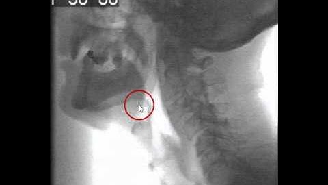 How to Identify Anatomical Landmarks on Videofluorscopy