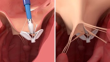 PASCAL repair system - Implantation in the tricuspid valve | Animation