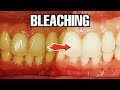 Bleaching Gigi | Dokter Gigi Tri Putra
