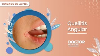 Queilitis angular