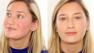 How Cover Acne, Redness Blemishes - YouTube