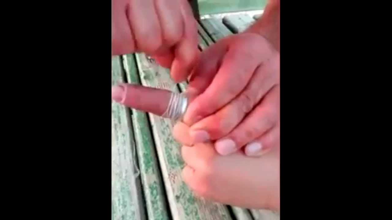Как снять кольцо с опухшего пальца видео