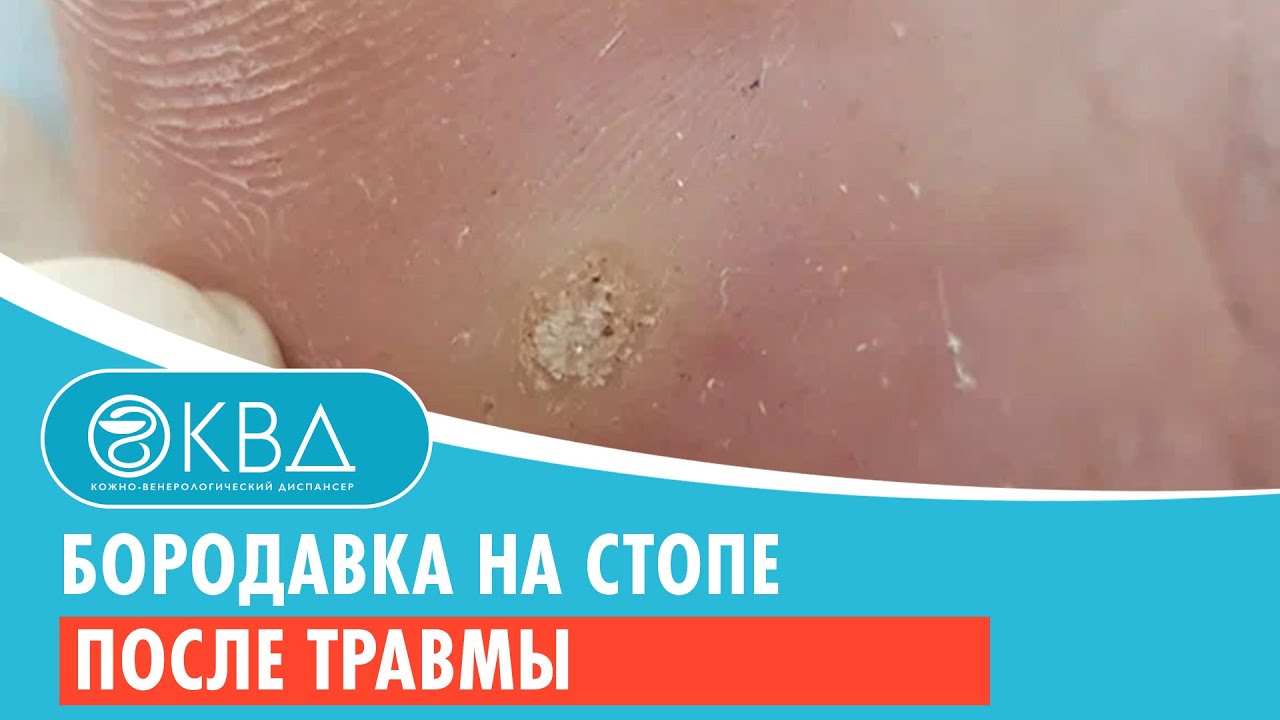 🦶 Бородавка на стопе после травмы. Клинический случай №713 - YouTube