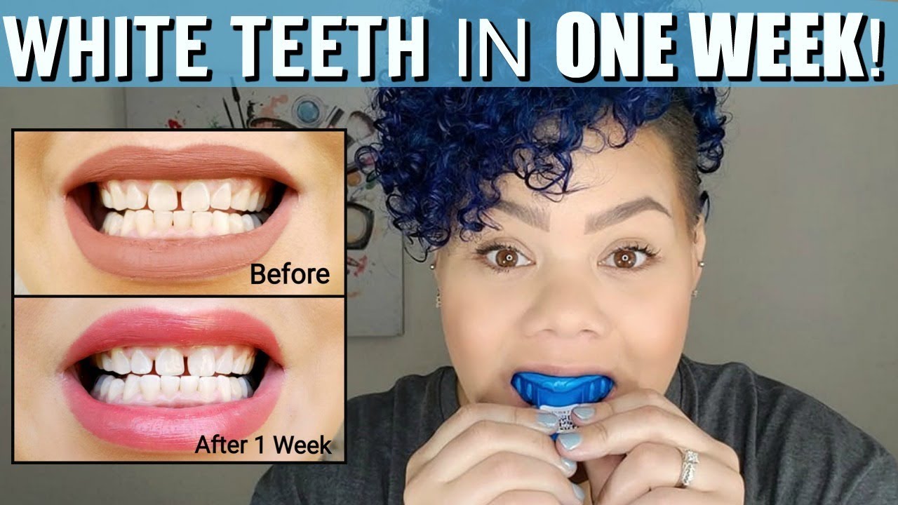 EASY TEETH WHITENING at HOME GIVEAWAY! with SMILE BRILLIANTCLOSED