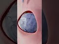 Ganglion Cyst Removal Surgery 3D Animation Ganglioncyst