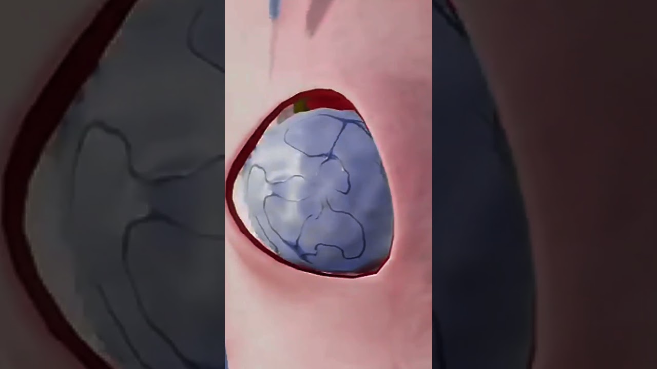 Ganglion Cyst Removal Surgery-3D Animation 