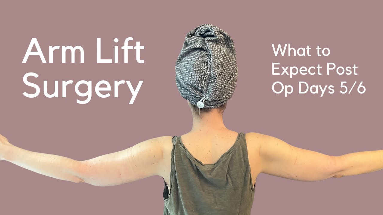 Arm Lift Post Op Days 5/6 Update YouTube