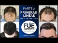 PRIMERAS LÍNEAS por el Dr. Juan Couto - FUExpert Clinic - Trasplantes capilares en España - PARTE 2