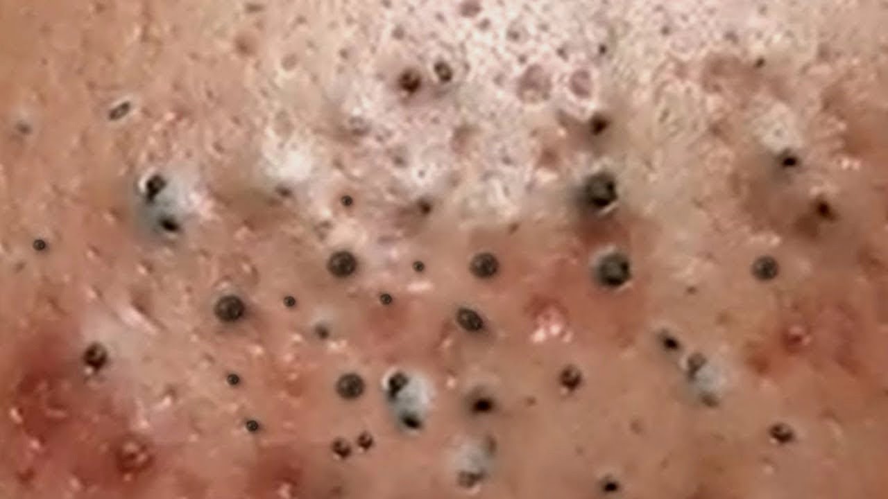 Big Pimple popping 2023 Removal Blackhead and Whitehead 2023 YouTube