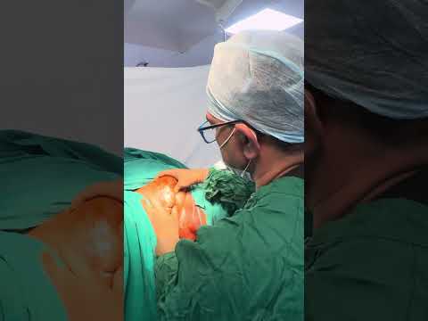 Fistula Problem of Young Girls spreads to Private Part  Lips of Vaginal & Hidradenitis suppurativa