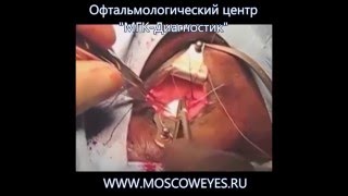 Удаление глаза - операция энуклеации Удаление глаза - операция энуклеации
