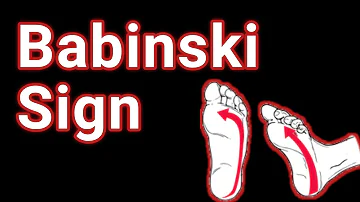 Is Babinski reflex always present in MS?
