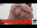 HUGE PAINFUL CALLOUS REMOVAL ***AND HOW TO STOP IT FROM GROWING***