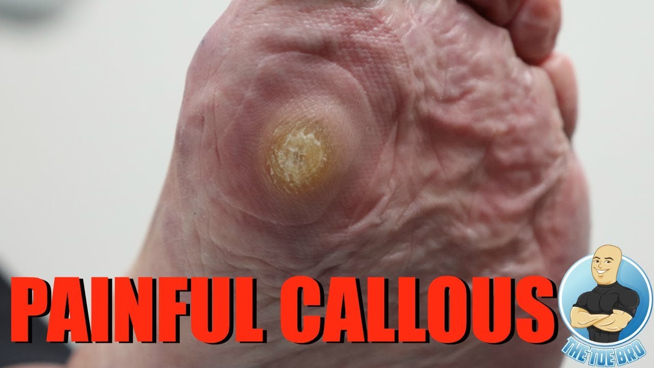 HUGE PAINFUL CALLOUS REMOVAL ***AND HOW TO STOP IT FROM GROWING***