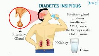 diabetes insipidus (English) - Medical terminology for medical students -