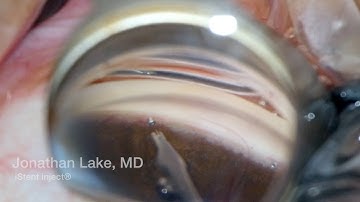 iStent inject underimplant