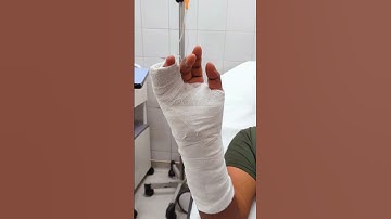 Short Arm Ulnar Gutter Splint. #emergencymedicine #doctor #er #orthopedics #orthodox