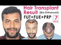 Best Hair Transplant Results | 7 Months Hair Transplant Result in India @ Medispa Jaipur Rajasthan