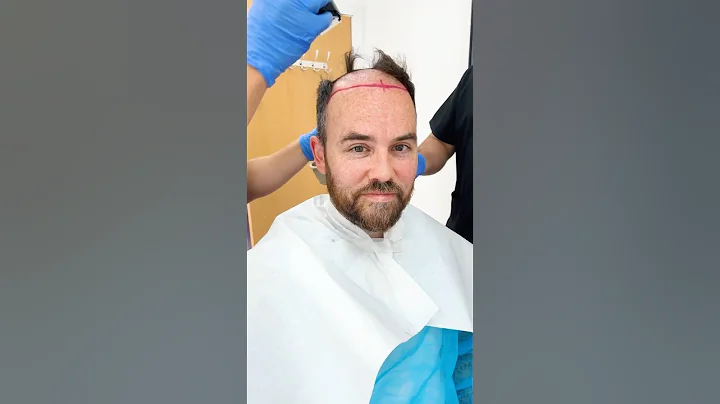 Was this a mistake? 😬 #shorts #sacconejolys #hair #hairtransplant