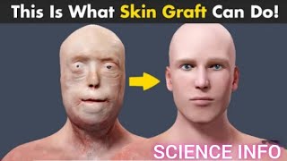 How Skin Transplant ( Skin Graft) is performed  Skin Graft Procedure (Urdu/Hindi)Skinanimation