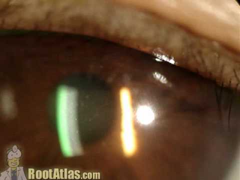 Cell and flare in the eye (Video) 
