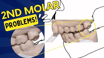 Last Tooth In the Arch Syndrome - 2nd Molar Space Loss After Crown Prep - PDP130