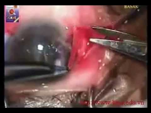M 08  Phẫu thuật cắt mộng