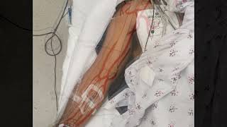 Locating The Brachial Artery For A Blood Gas Sample