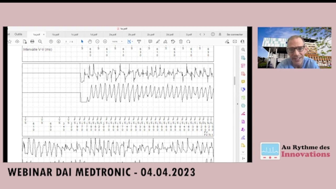 L’analyse des tracés des DAI Medtronic