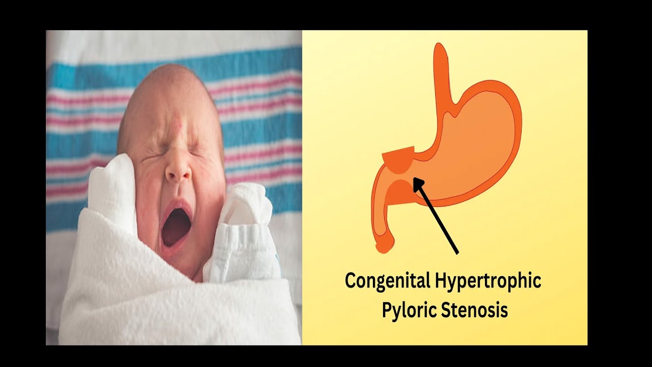 hypertrophic-pyloric-stenosis-youtube