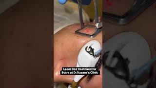 LASER CO2 TREATMENT FOR SCARS AT Dr.Kasanas Clinic