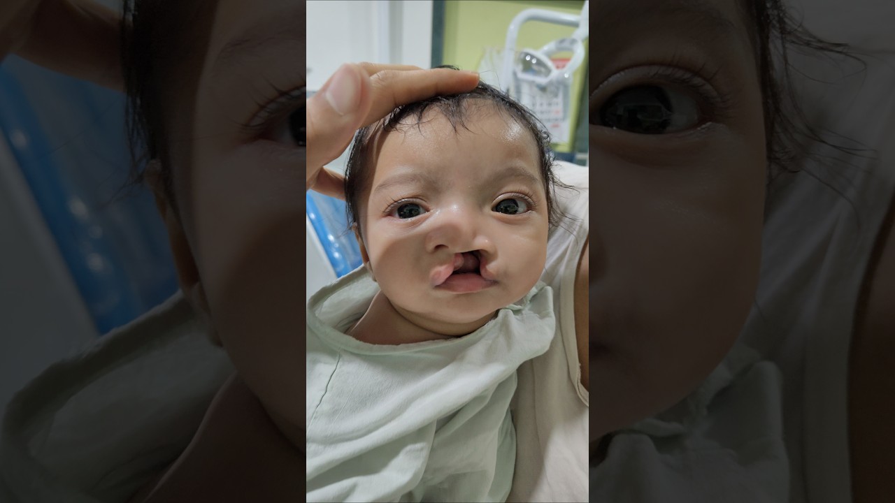 A Cute Cleft Child : Just before undergoing Cleft Lip Repair Surgery