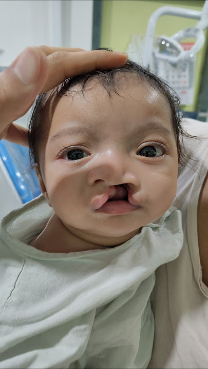 A Cute Cleft Child : Just before undergoing Cleft Lip Repair Surgery