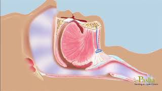 Advanced Oral Surgeries For Sleep Apnea screenshot 4